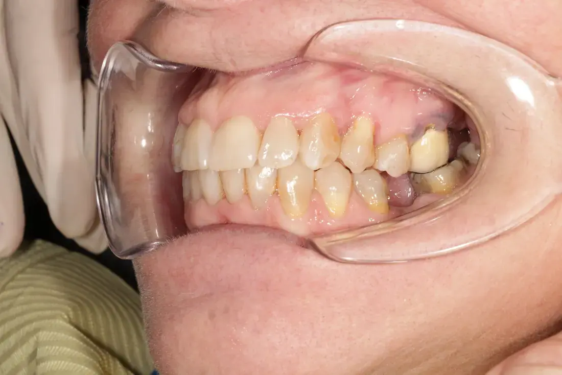 Lateral izquierda despues
