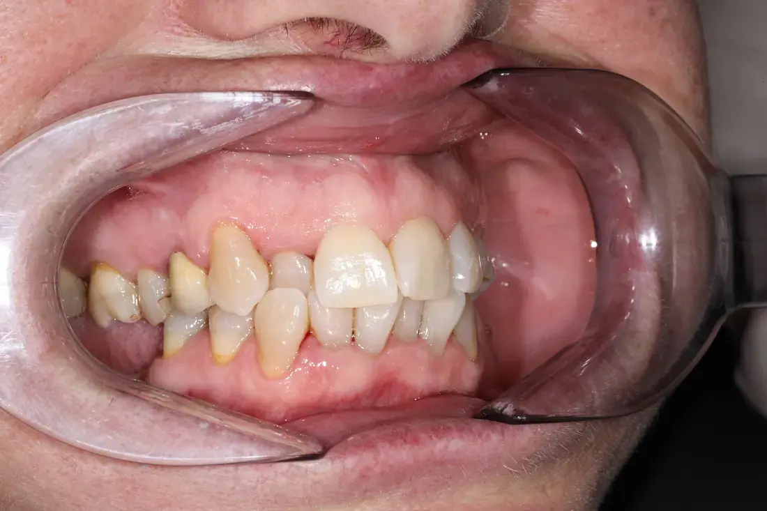 Lateral derecha antes