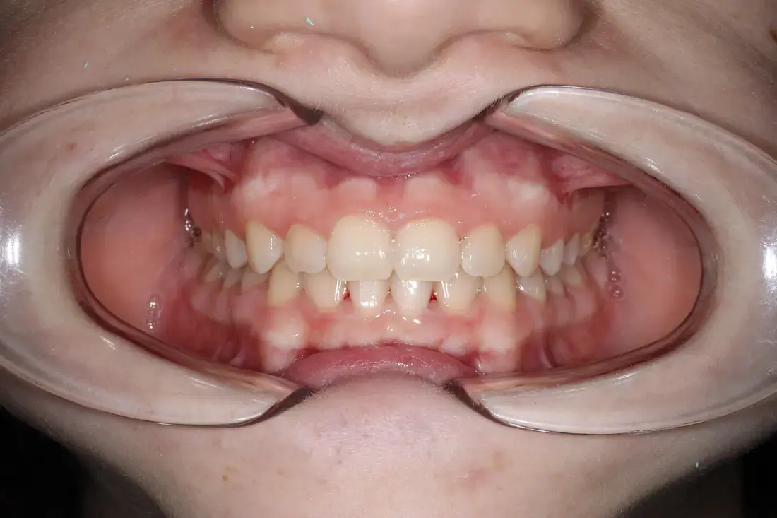 Frontal despues