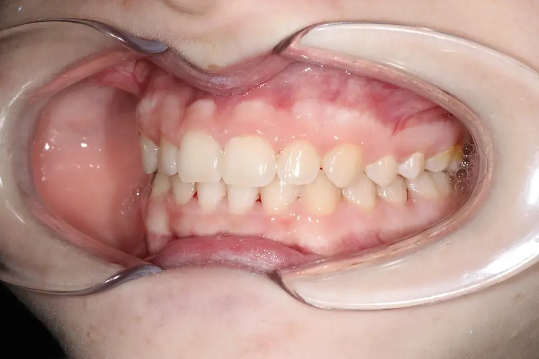 Lateral izquierda despues