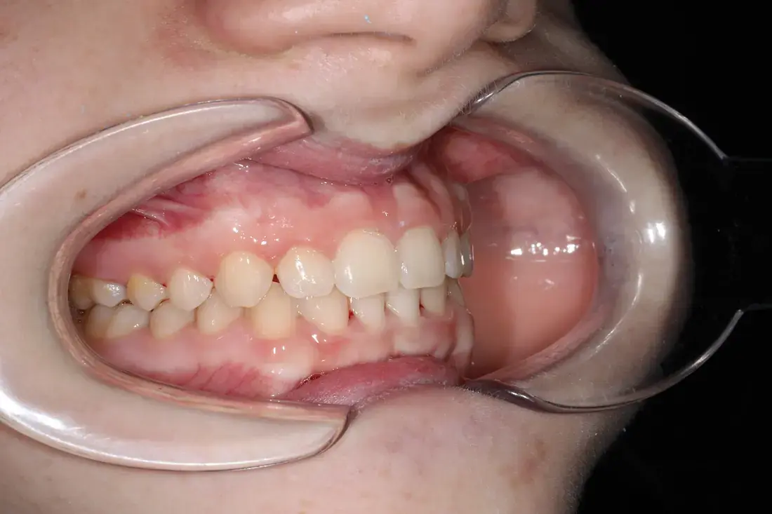 Lateral derecha despues