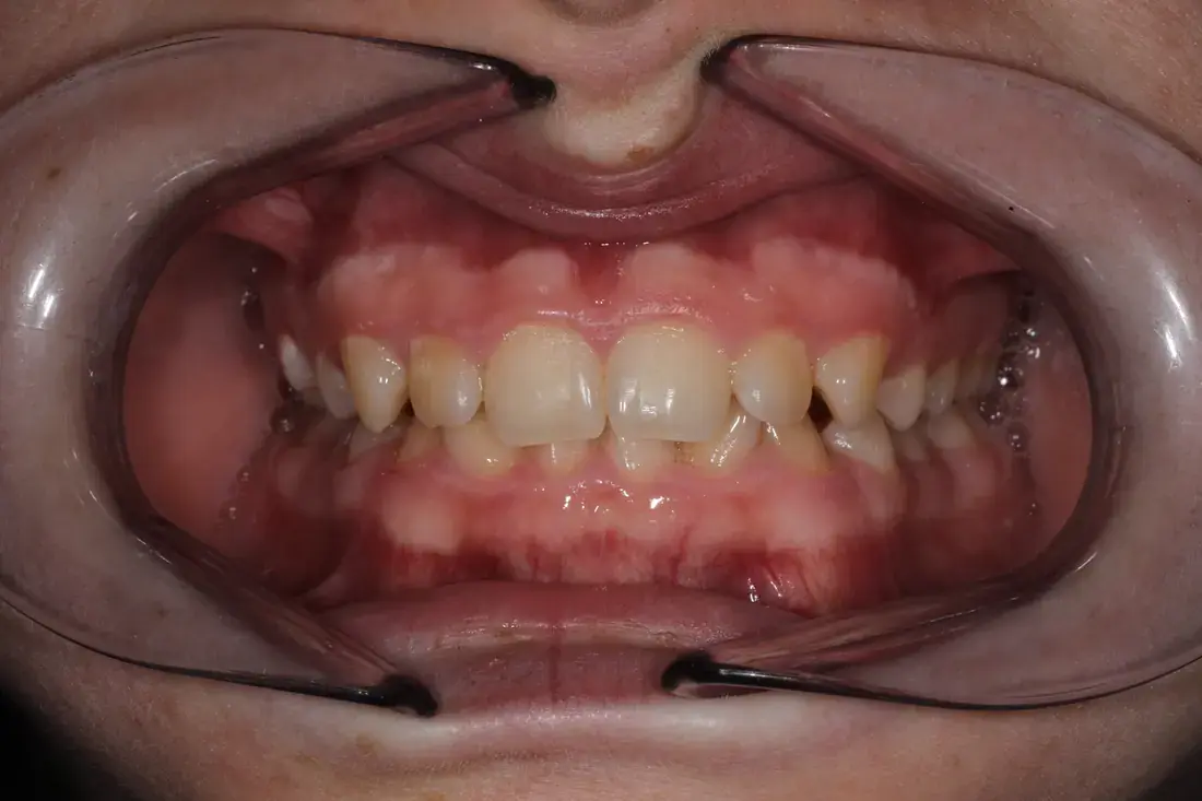 Frontal antes