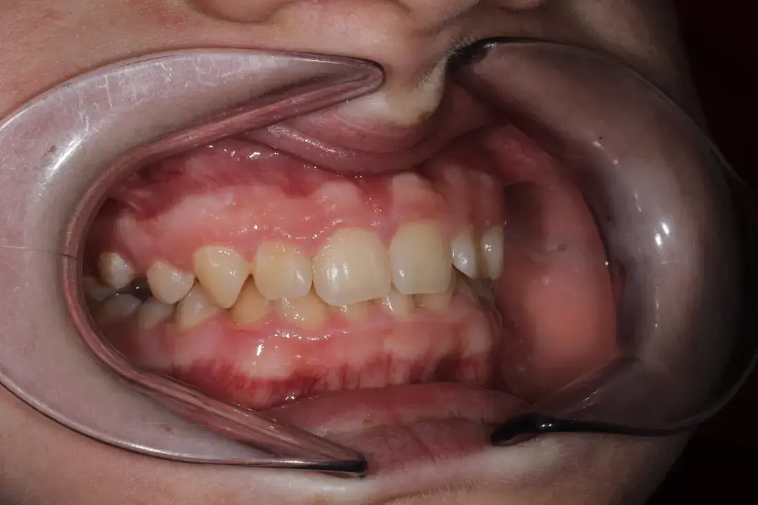 Lateral derecha antes