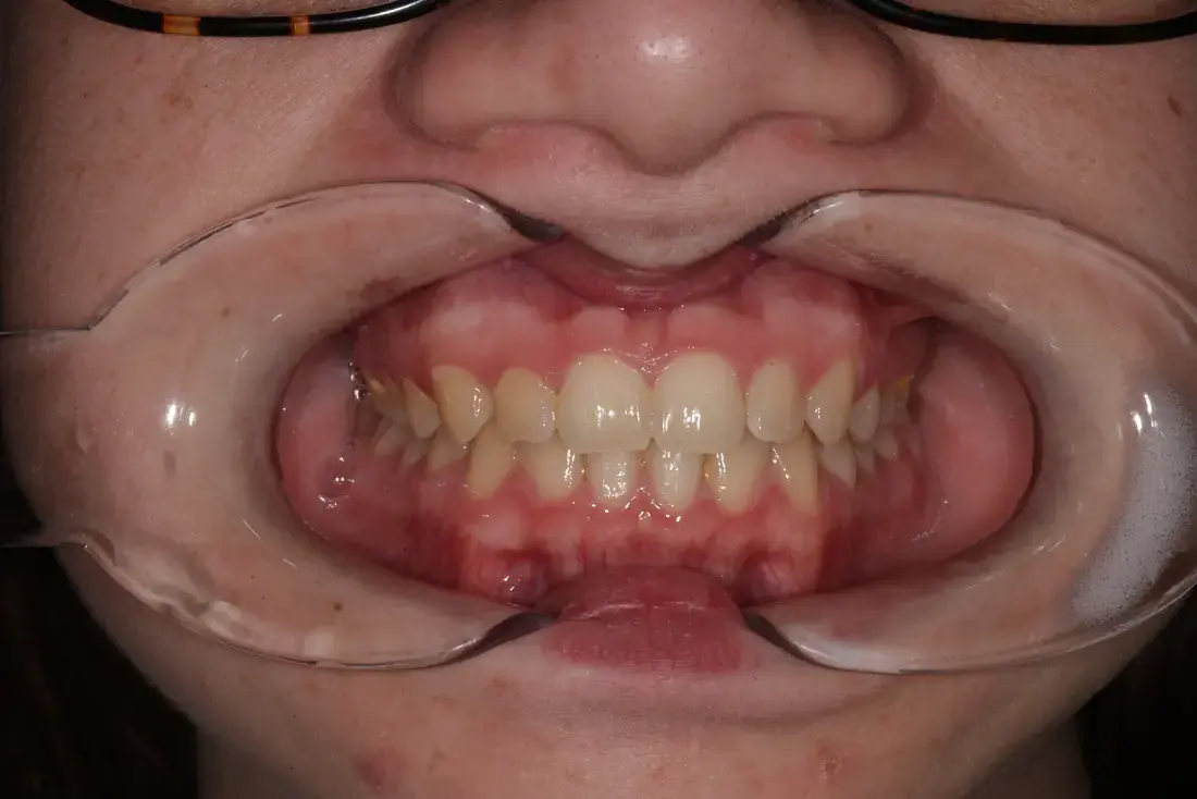 Frontal imagen intraoral