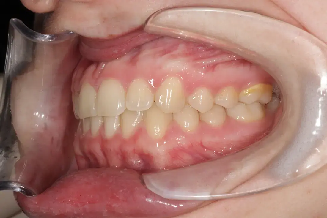Lateral izquierda imagen intraoral
