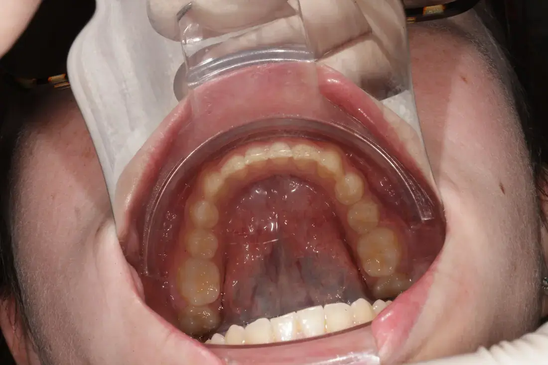 Arcada inferior imagen intraoral