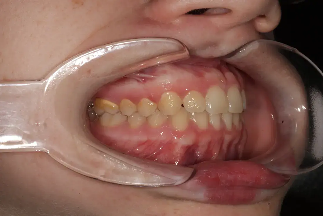Lateral derecha imagen intraoral