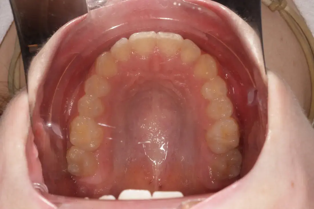 Arcada superior imagen intraoral
