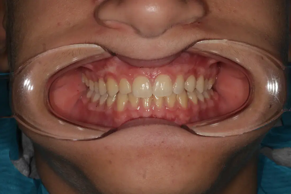Frontal after