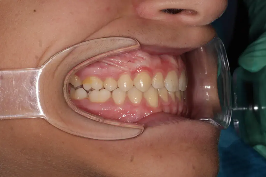 Right lateral after