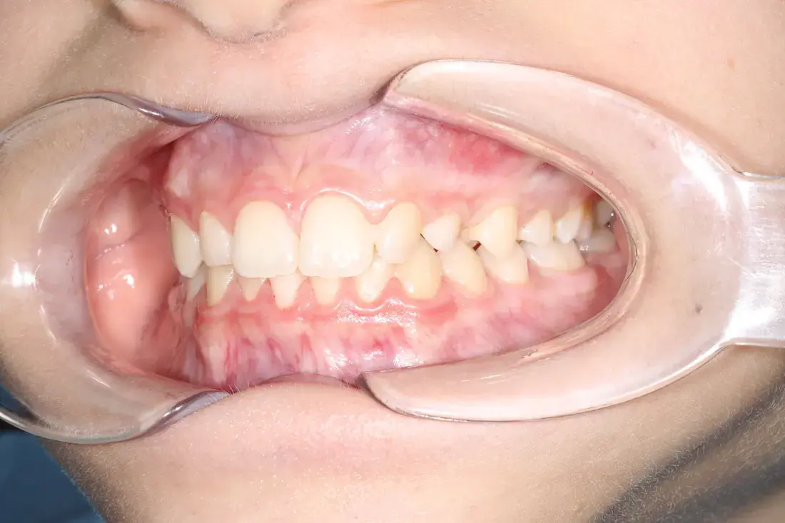 Left lateral before