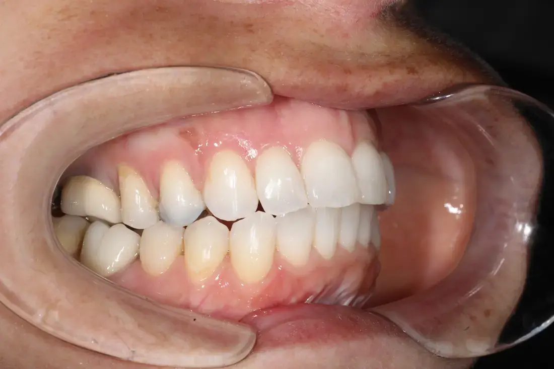 Right lateral after