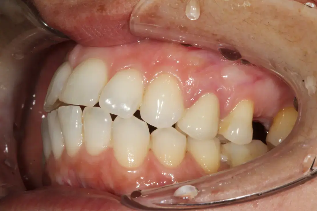 Left lateral before