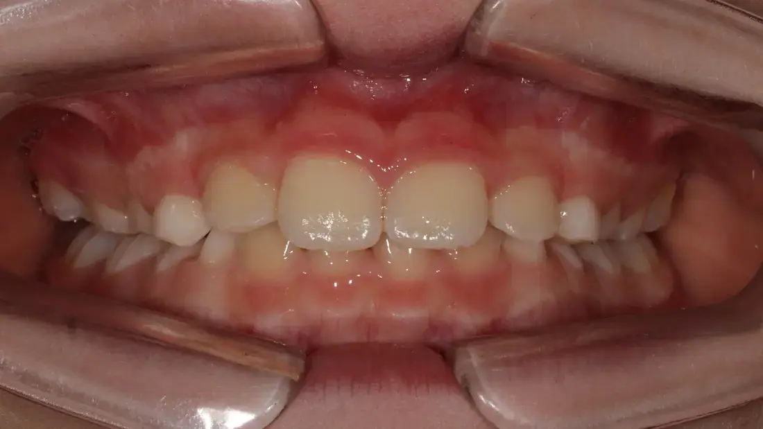 Frontal after