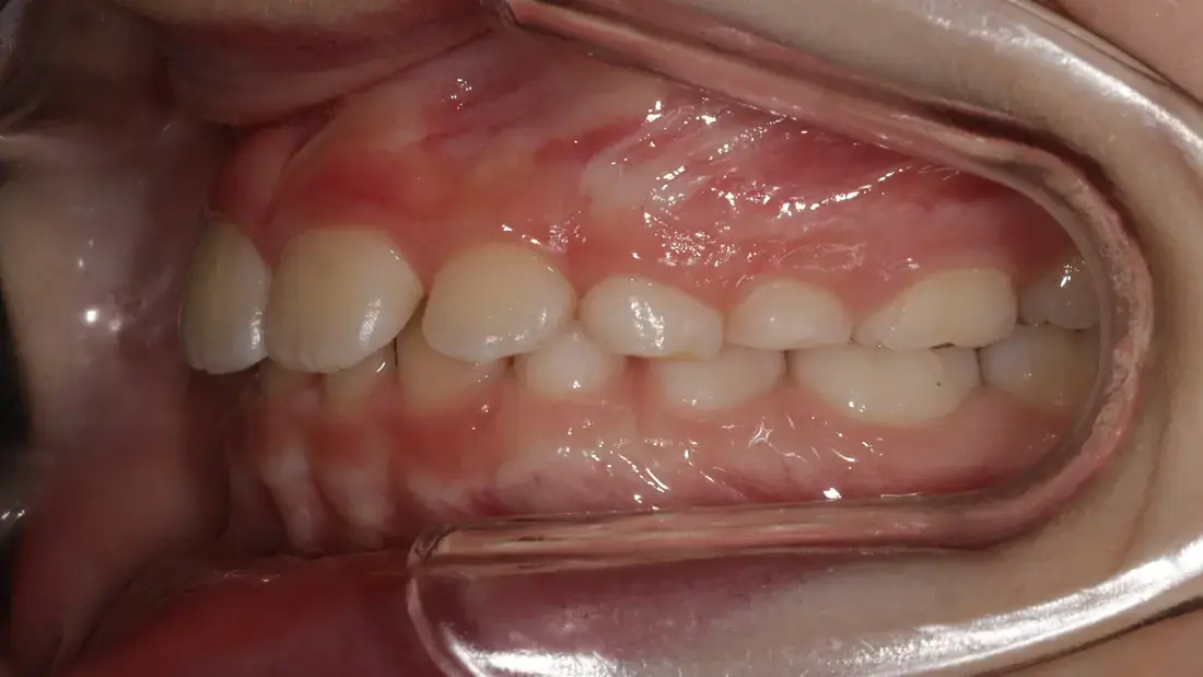Left lateral after