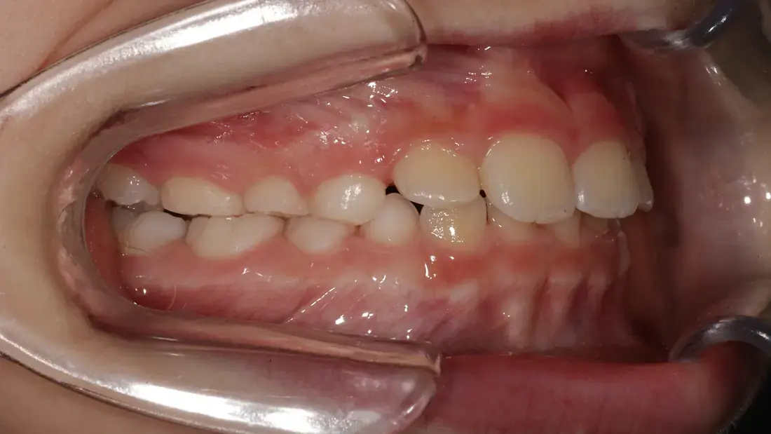 Right lateral after