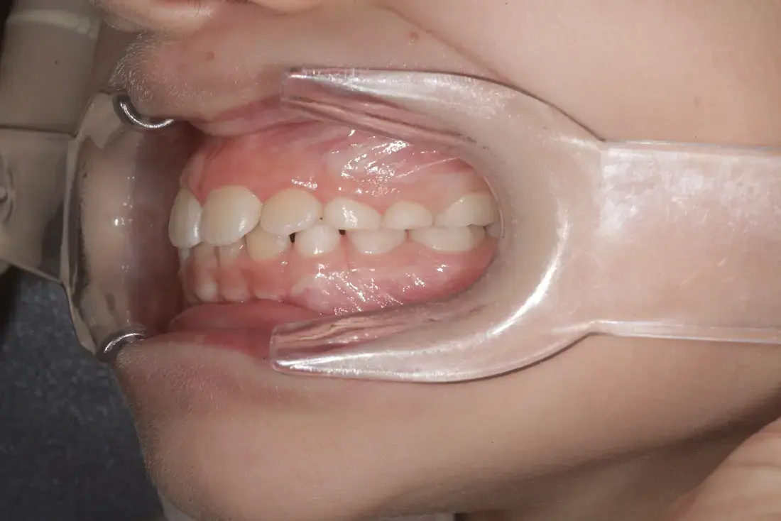 Left lateral before