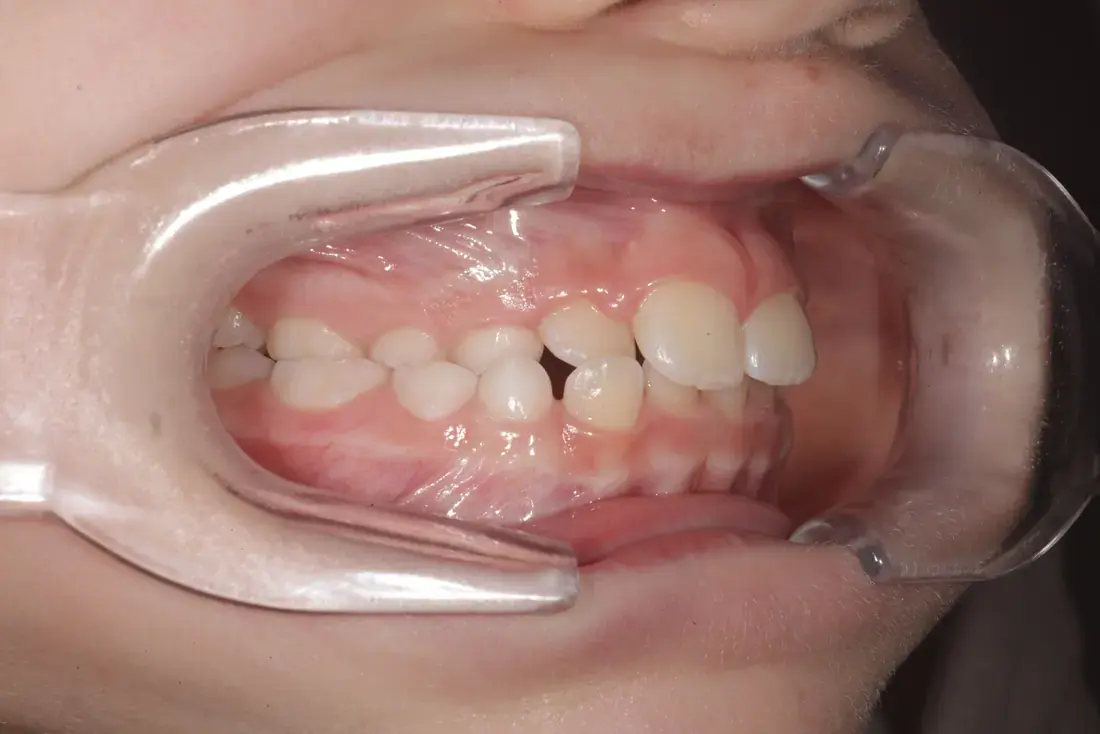 Right lateral before