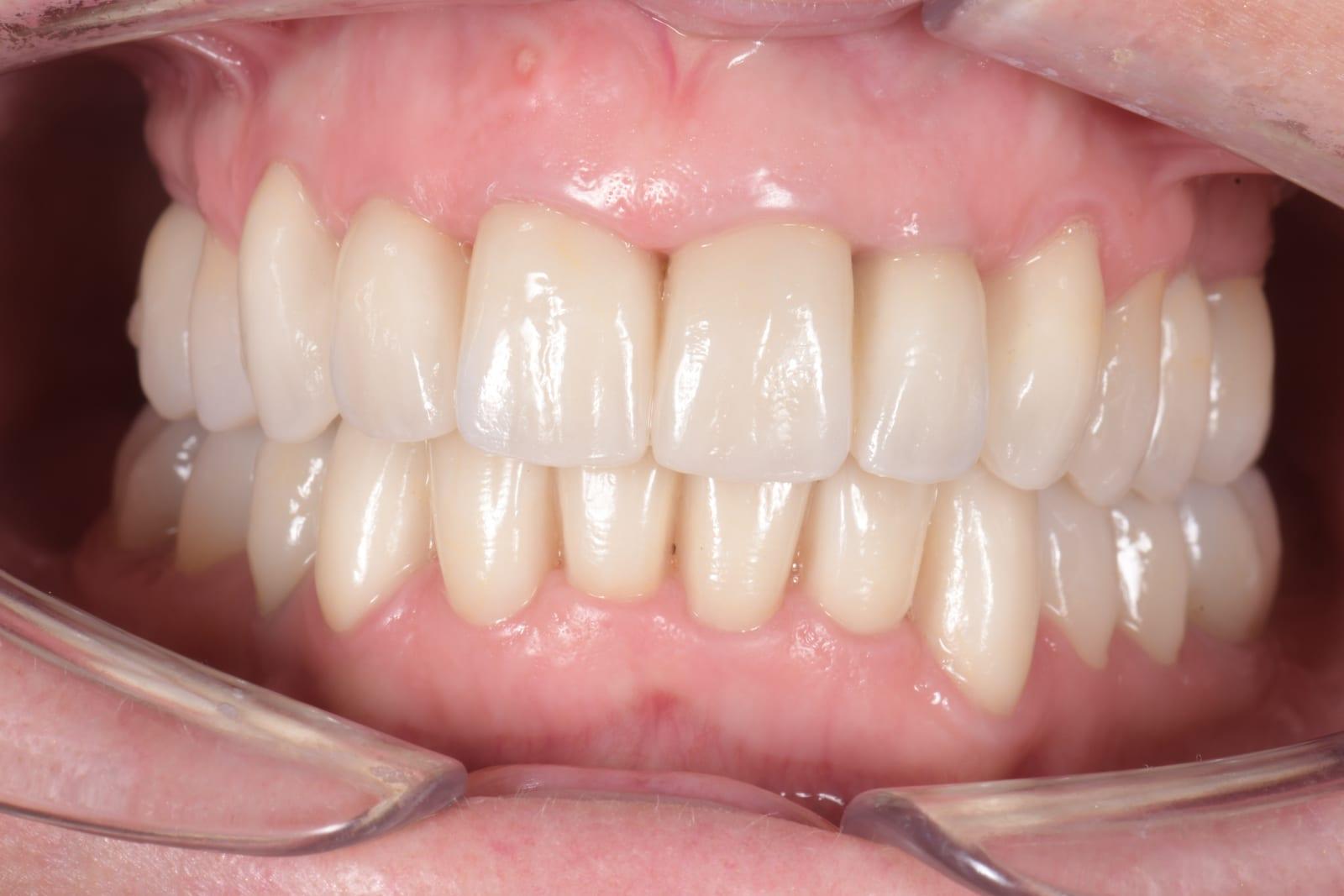 Smile after pre-prosthetic orthodontic treatment