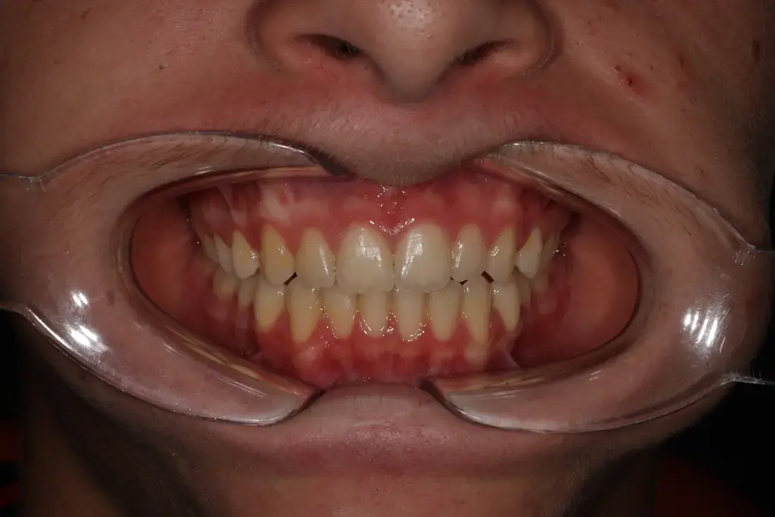 Frontal after