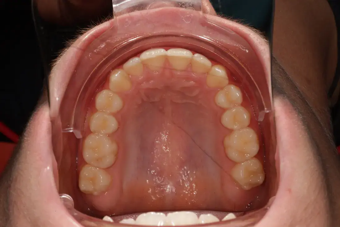 Upper arch after
