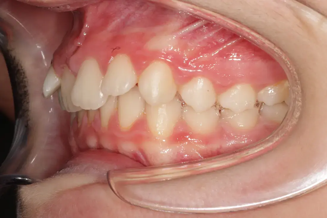 Left lateral before