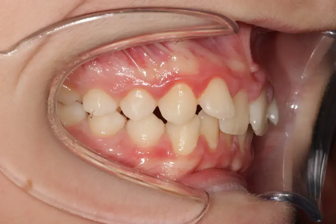 Right lateral before