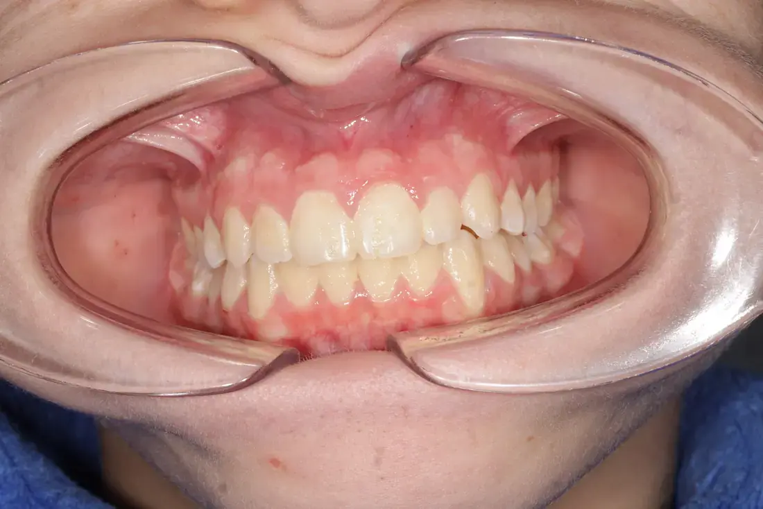 Frontal after