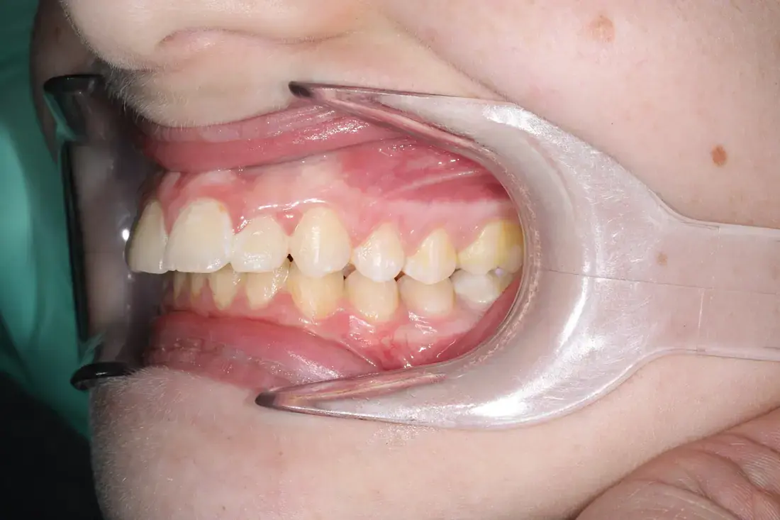 Left lateral before