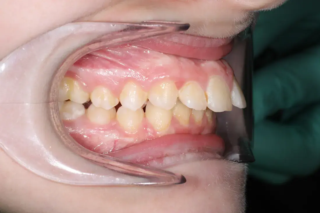 Right lateral before