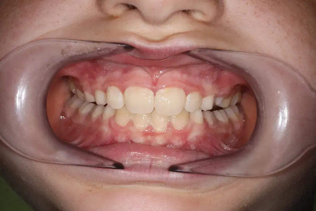 Frontal after