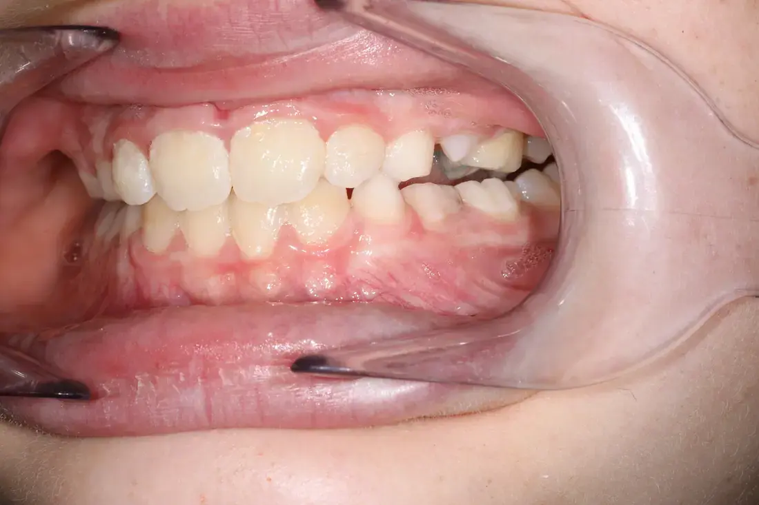 Left lateral after