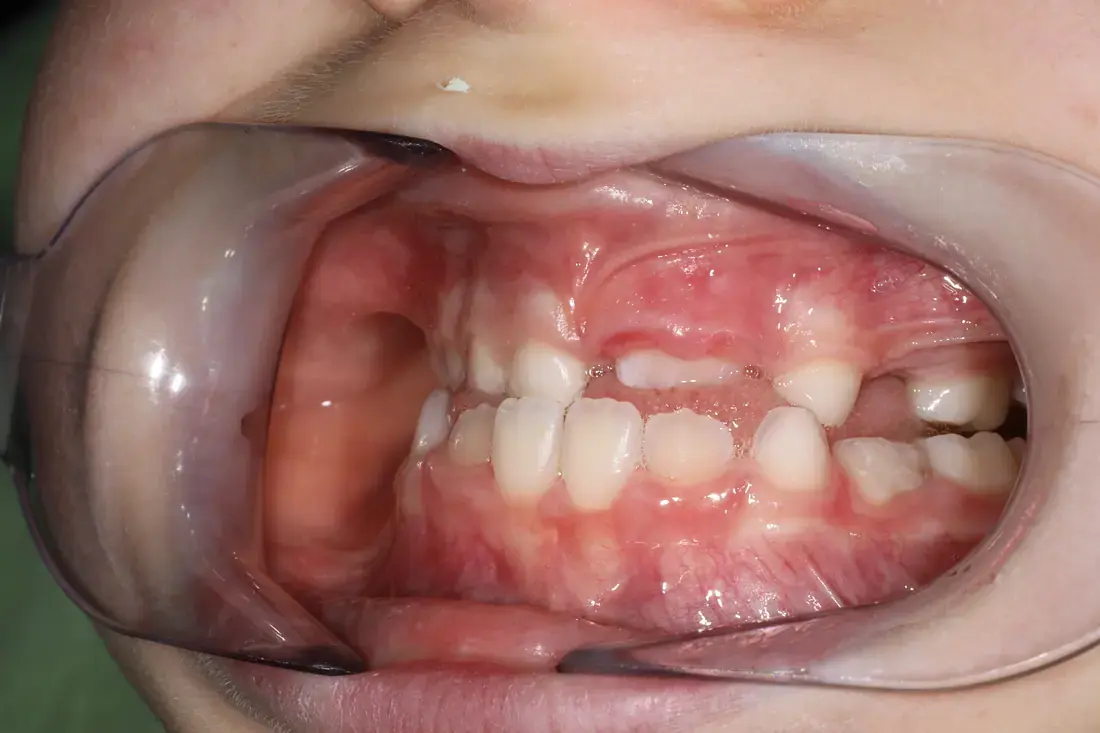 Left lateral before