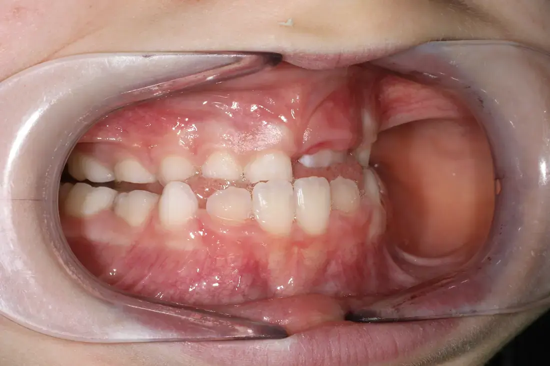 Right lateral before