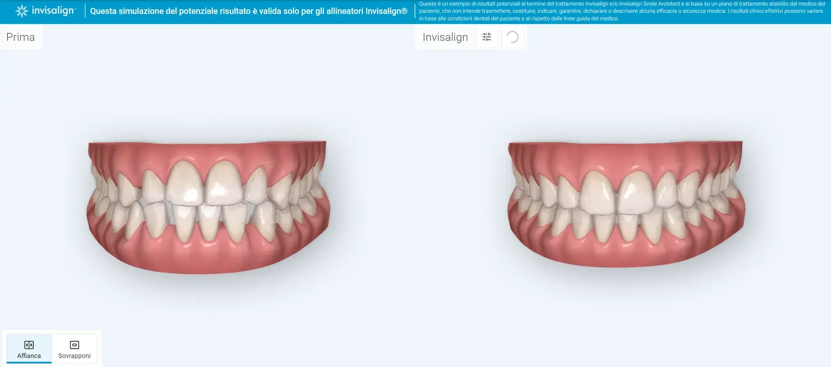 Simulacion digital antes y despues del tratamiento